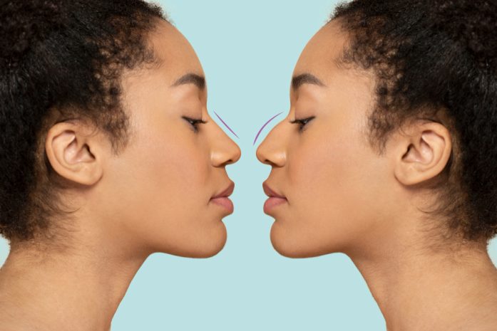 chirurgie nez rhinoplastie cannes nice docteur belhassen