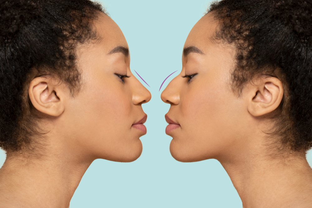 chirurgie nez rhinoplastie cannes nice docteur belhassen