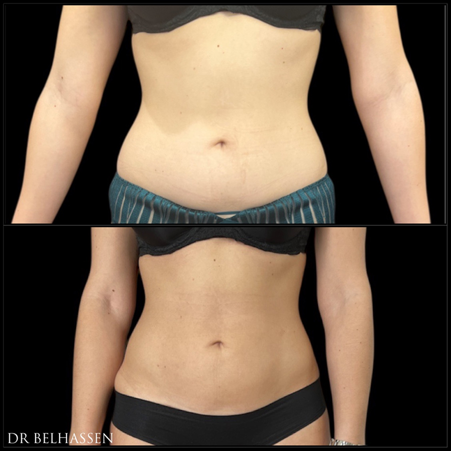 lipoaspiration avant apres dr belhassen 02